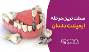 سخت ترین مرحله ایمپلنت دندان کدام است؟