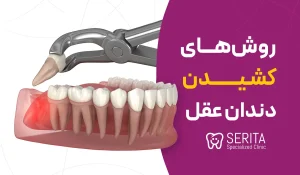 روش‌های کشیدن دندان عقل: راهنمای جامع