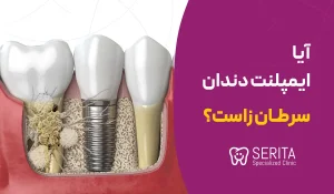 آیا ایمپلنت دندان سرطان زاست؟