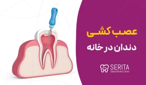 آیا عصب کشی دندان در خانه امکان پذیر است؟
