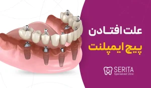 علت افتادن پیچ ایمپلنت + جلوگیری، راهکار و درمان