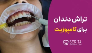 آیا برای کامپوزیت دندان را میتراشند؟