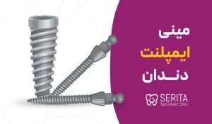 مینی ایمپلنت دندان از هزینه تا مزایا و کاربرد