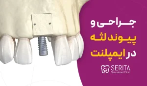 جراحی و پیوند لثه در ایمپلنت چرا و چگونه انجام می‌شود؟