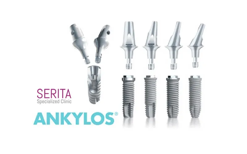 ایمپلنت انکیلوز (Ankylos)