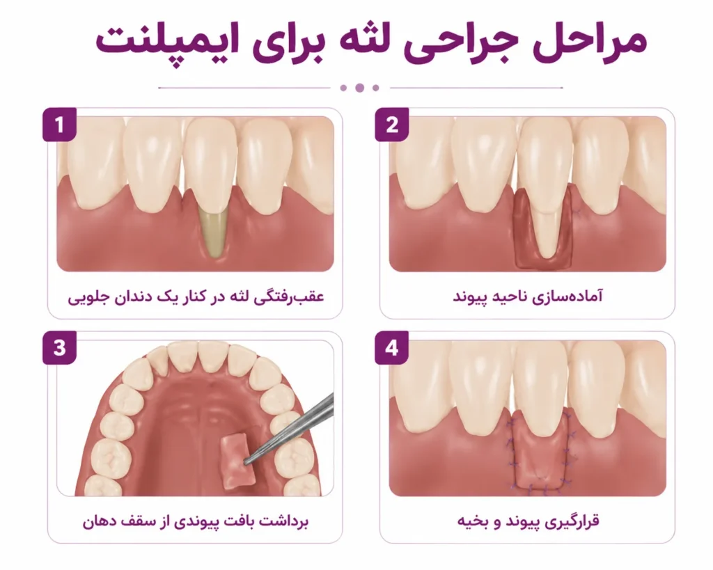 مراحل جراحی لثه برای ایمپلنت