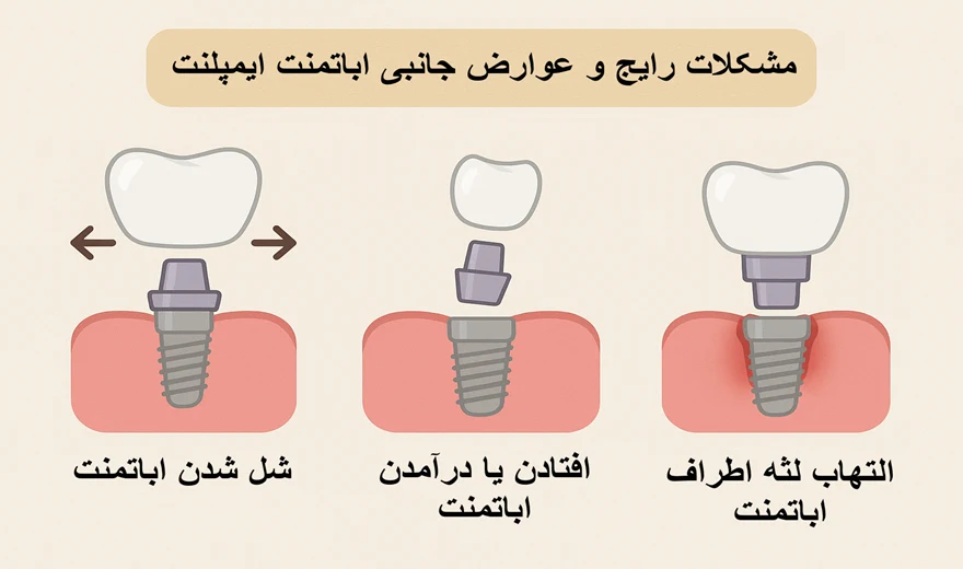 مشکلات رایج و عوارض جانبی اباتمنت ایمپلنت.