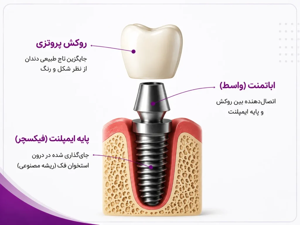 اجزای ایمپلنت برای درک قرارگیری فیکسچر 