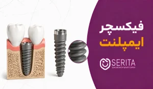 فیکسچر ایمپلنت دندان چیست؟ | بررسی کامل انواع و مراحل پایه ایمپلنت
