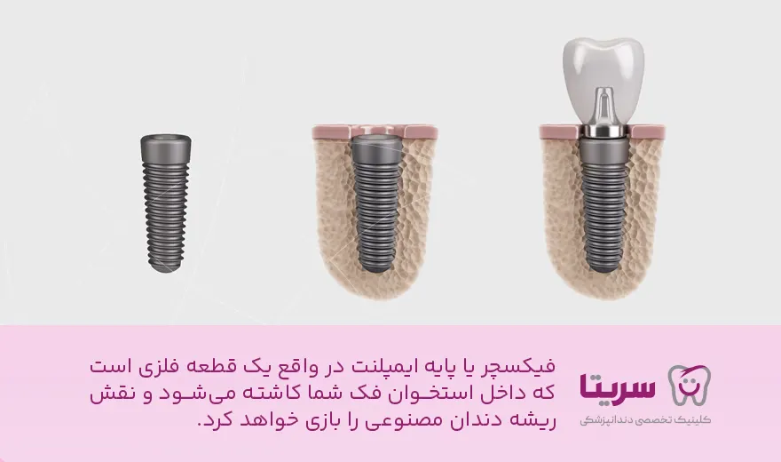 اینفوگرافیک فیکسچر دندان.