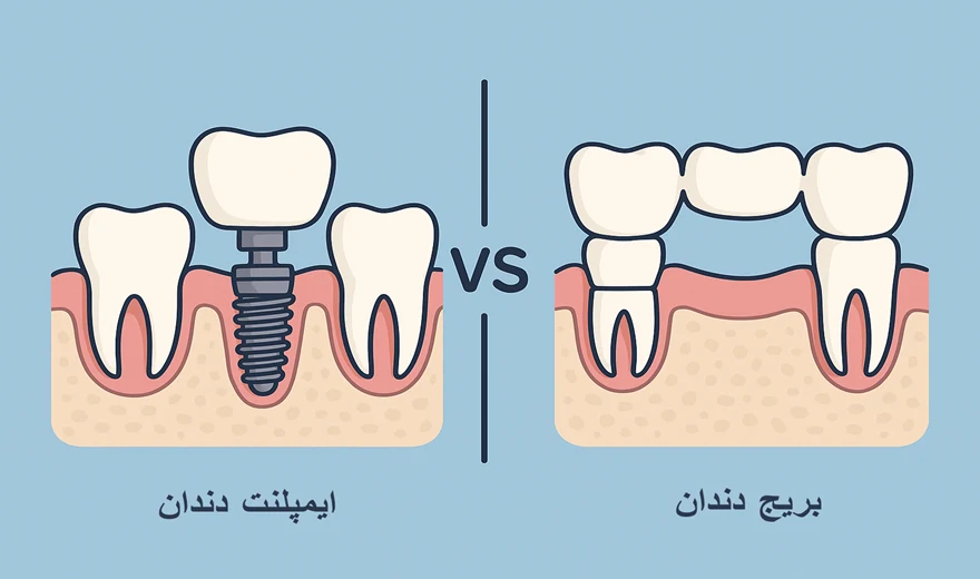 تفاوت بریج و ایمپلنت دندان