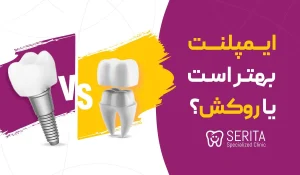 ="ایمپلنت