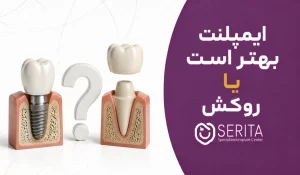ایمپلنت بهتر است یا روکش؟ مقایسه کامل + تحقیقات جهانی
