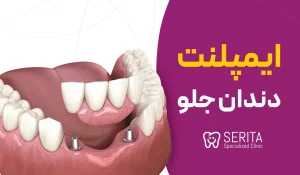="ایمپلنت