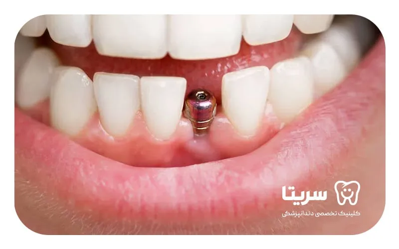 پیچ ایمپلنت دندان جلو