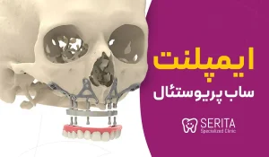ایمپلنت ساب پریوستئال | مراحل، کاندید مناسب، مزایا و ریسک‌ها