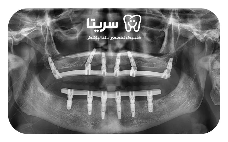 عکس رادیوگرافی ایمپلنت ساب پریوستئال