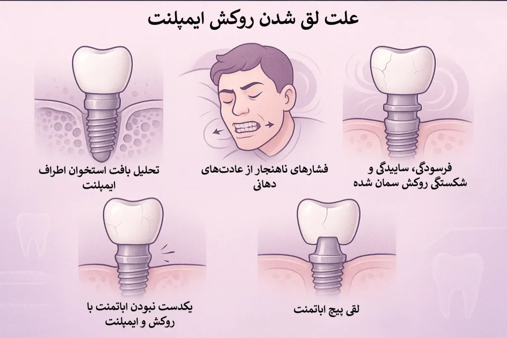 علت لق شدن روکش ایمپلنت