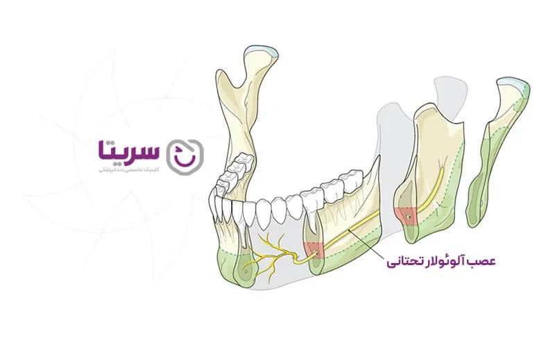 عصب آلوئولار تحتانی