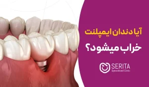 آیا دندان ایمپلنت خراب می‌شود؟ علائم، دلایل و پیشگیری از خرابی ایمپلنت