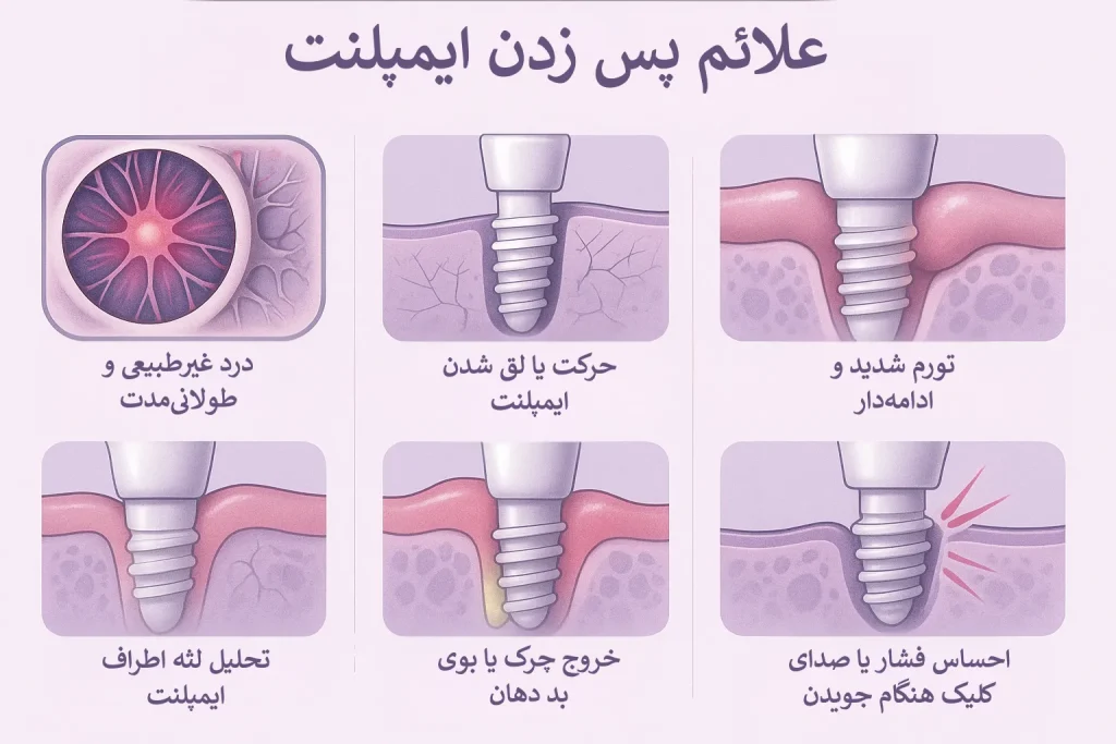 اینفوگرافیک علائم پس زدن ایمپلنت