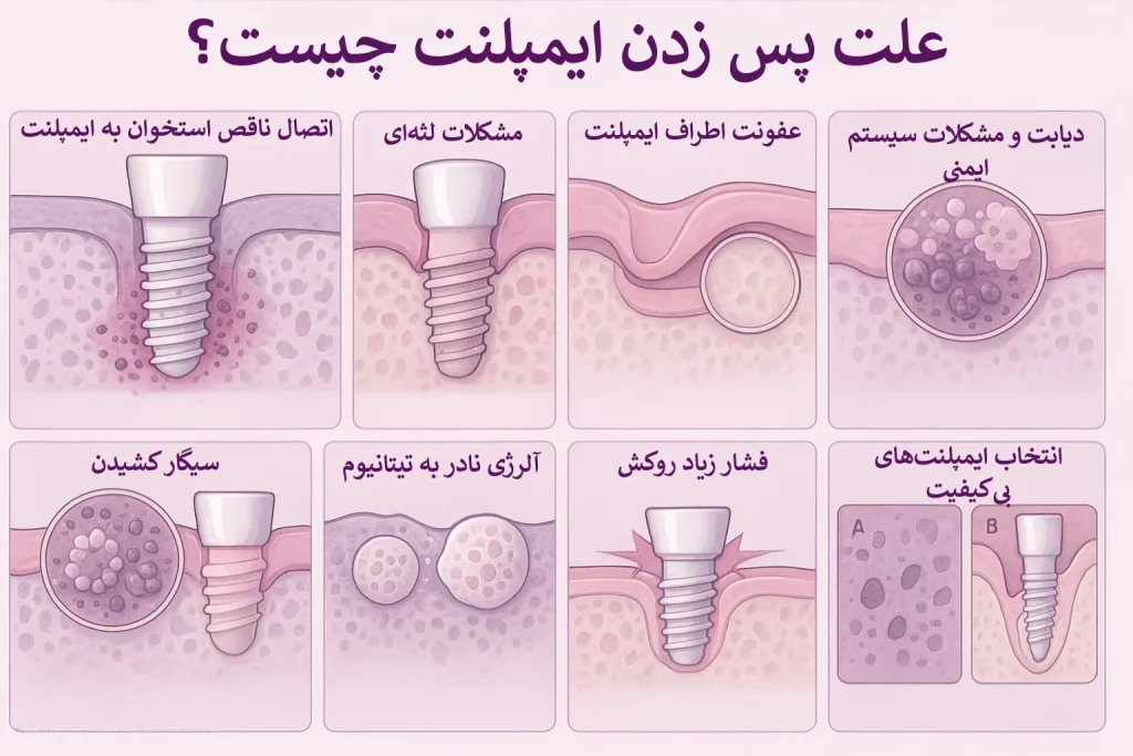 اینفوگرافیک علت پس زدن ایمپلنت