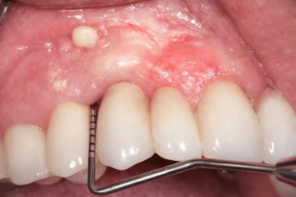 علائم التهاب لثه بعد از ایمپلنت خروج چرک است.