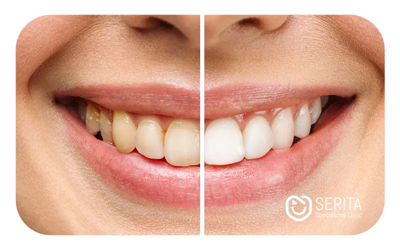 برای اثر خمیر دندان میسویک باید 10 روز تا یک ماه مورد استفاده قرار گیرد.