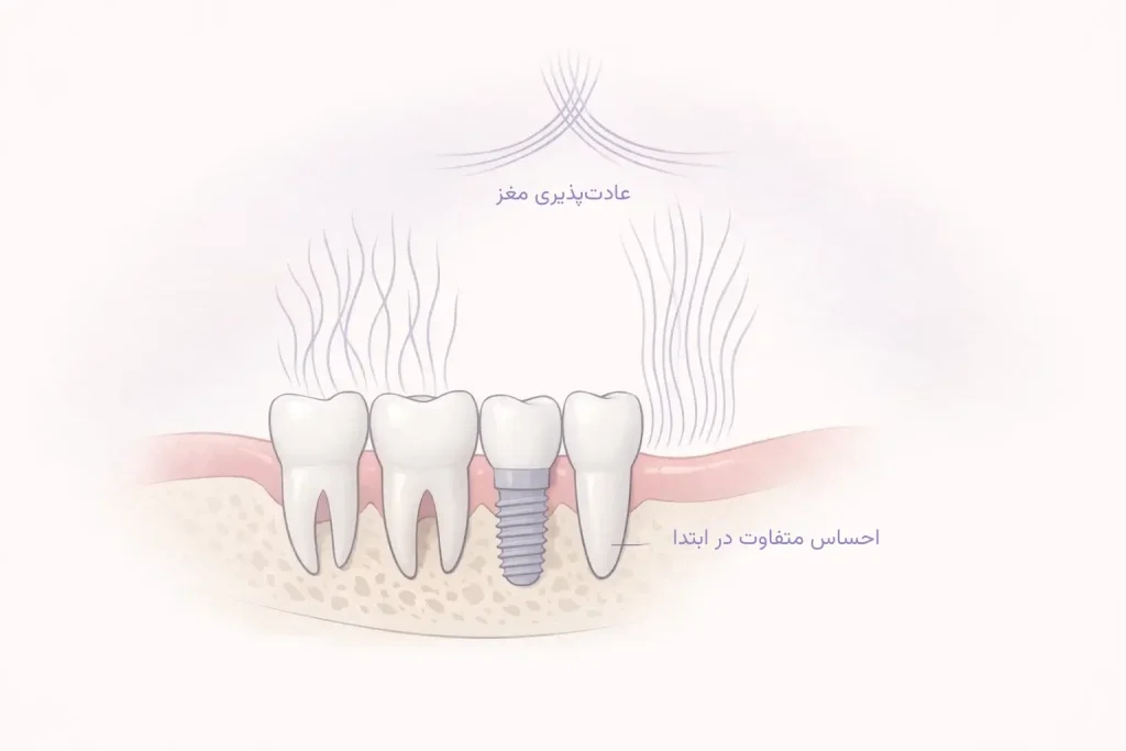 در ابتدا حس جویدن با دندان ایمپلنت طبیعی نیست؛ اما تبدیل به عادت میشود.