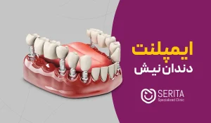ایمپلنت دندان نیش | مراحل + عوارض و هرآنچه باید بدانید!