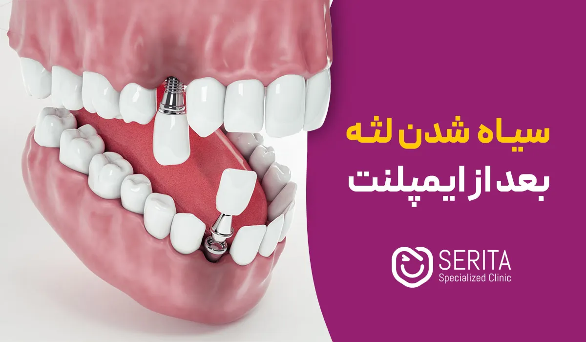 سیاه شدن لثه بعد از ایمپلنت؛ علت چیست و آیا جای نگرانی دارد؟