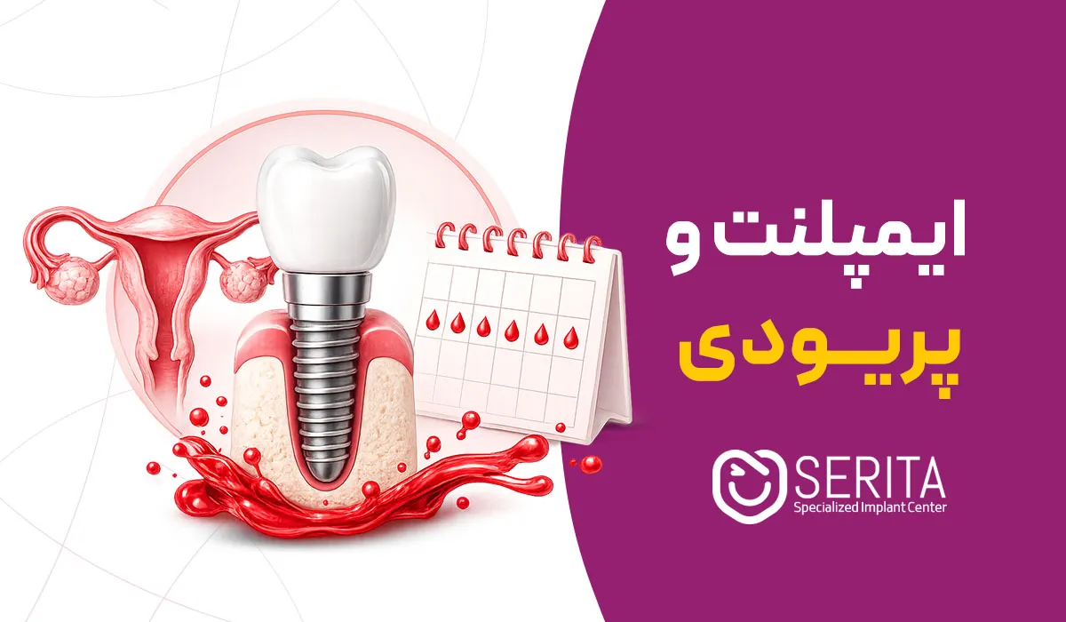 ایمپلنت دندان و پریودی؛ آیا این جراحی در دوران قاعدگی خطرناک است؟