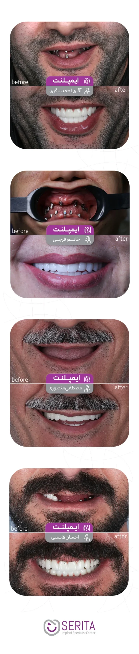 قبل و بعد از ایمپلنت دندان
