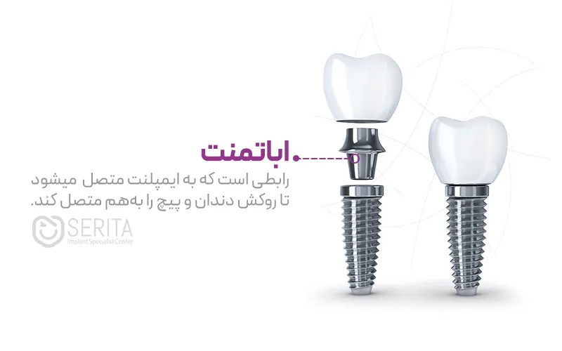 اباتمنت؛ اجزای ایمپلنت دندان