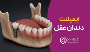 ایمپلنت دندان عقل