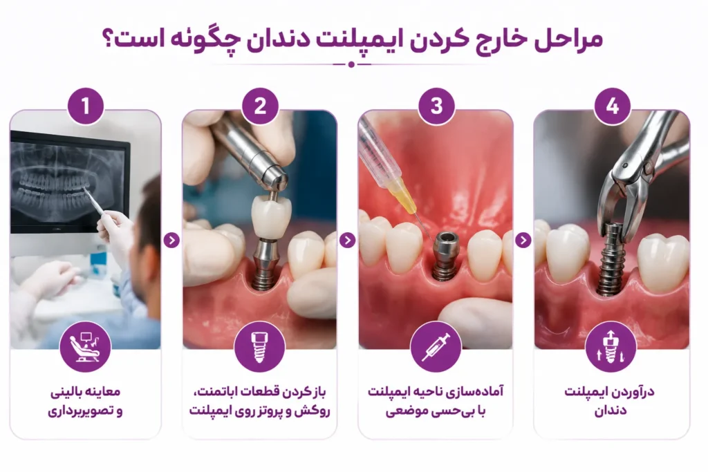 مراحل خارج کردن ایمپلنت دندان