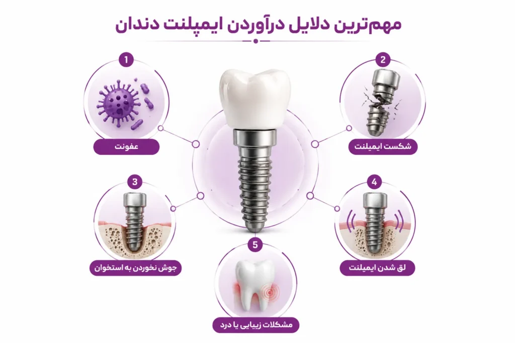 مهم‌ترین دلایل درآوردن ایمپلنت دندان 