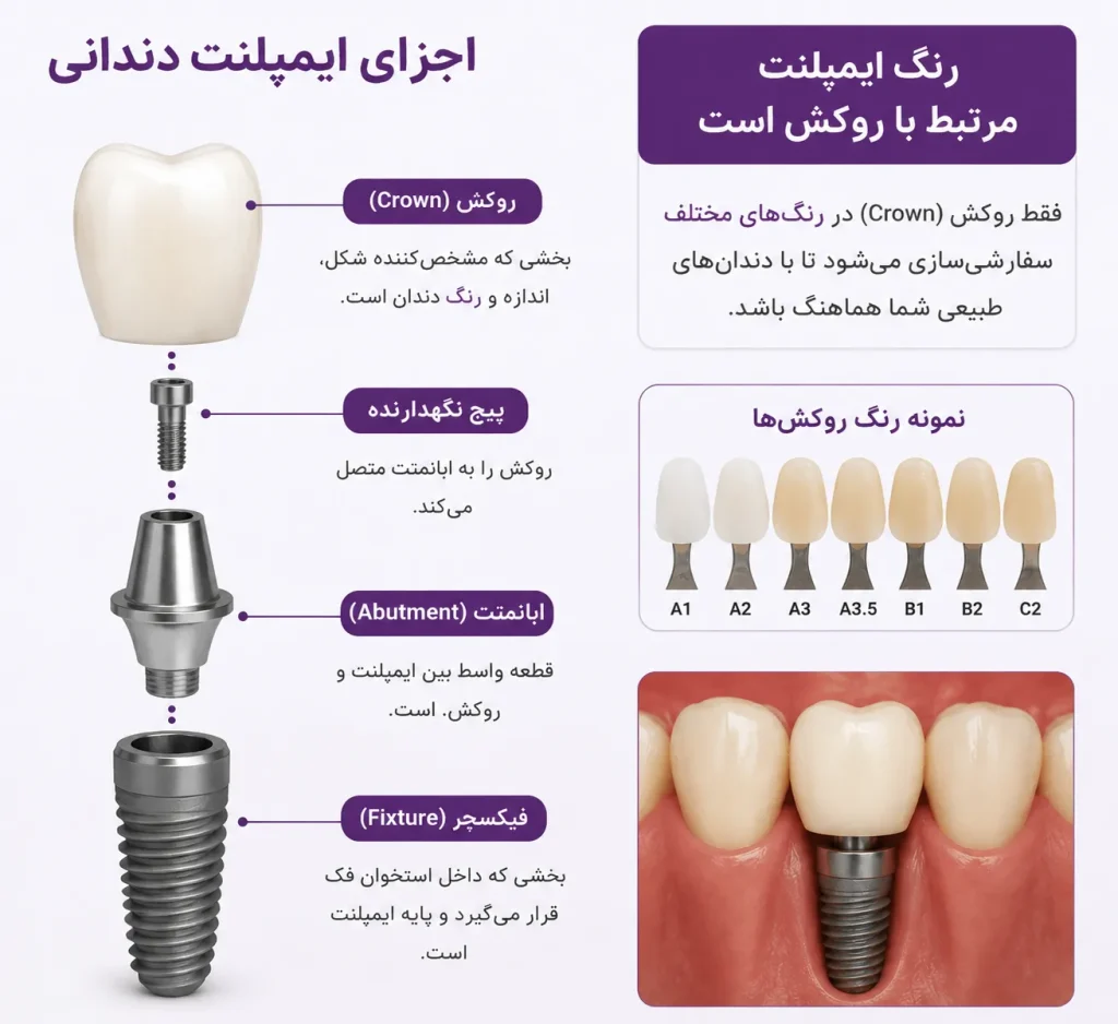 اینفوگرافیک اجزای ایمپلنت و بخش مربوط به انتخاب رنگ ایمپلنت