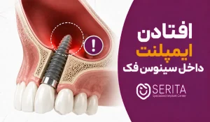 افتادن ایمپلنت داخل سینوس فک؛ علت، علائم و روش درمان