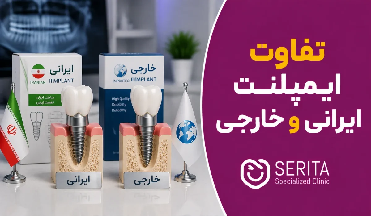 تفاوت ایمپلنت ایرانی و خارجی چیست؟ مقایسه کیفیت و قیمت